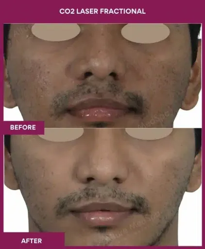 3 CO2 Laser Fractional