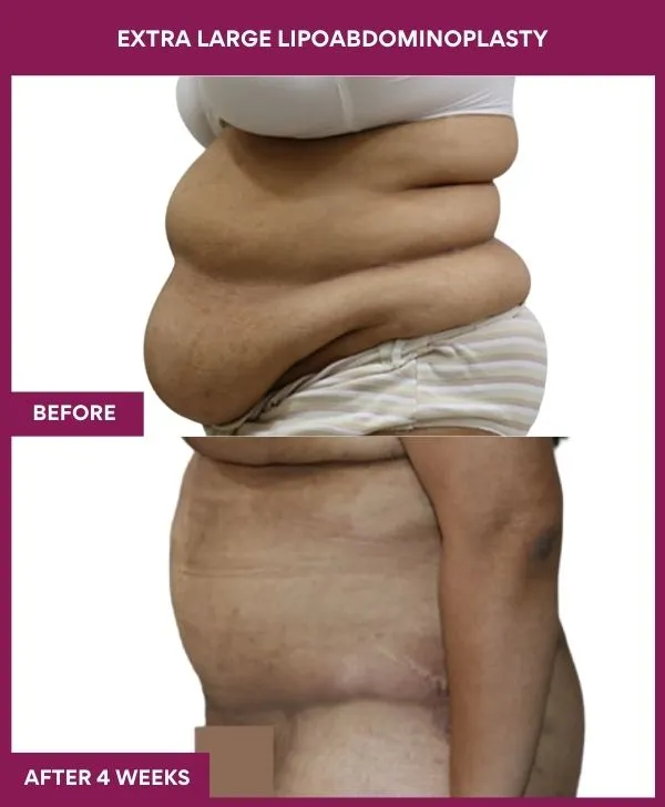 3 EXTRA LARGE LIPOABDOMINOPLASTY (6)_59_