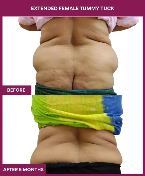 3 Extended Female Tummy Tuck (2)_33_