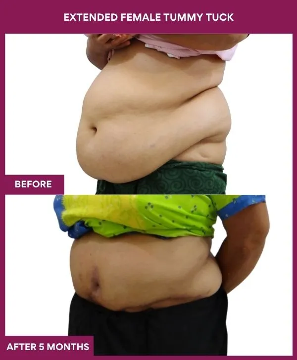 3 Extended Female Tummy Tuck (3)_33_