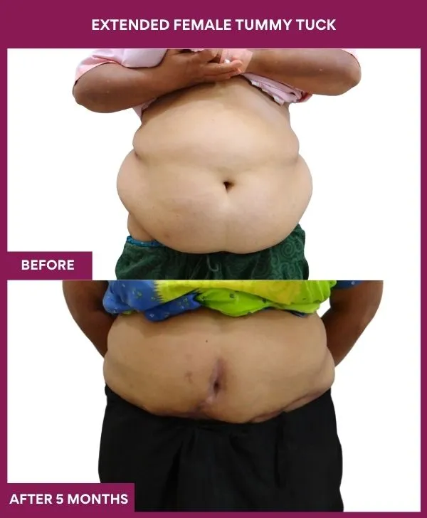 3 Extended Female Tummy Tuck (4)_33_