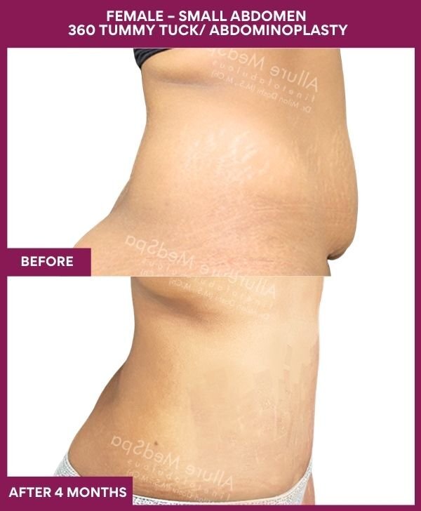 3 FEMALE – SMALL ABDOMEN 360 TUMMY TUCK_ ABDOMINOPLASTY (2)