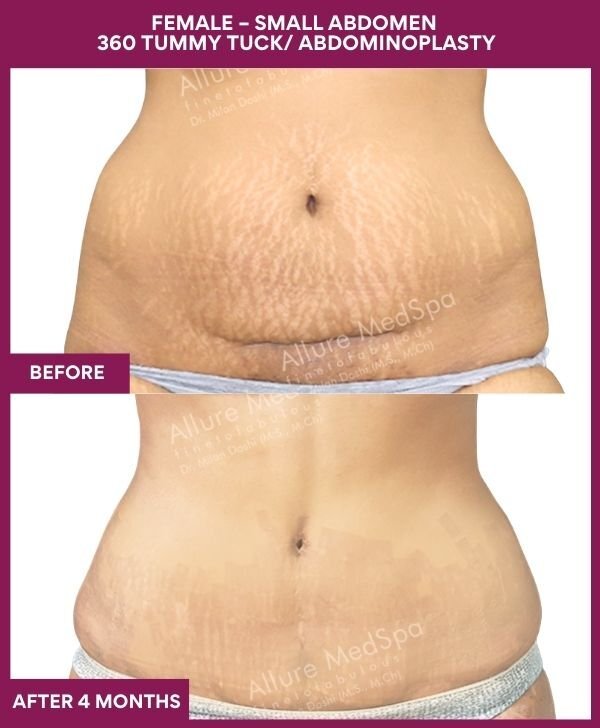3 FEMALE – SMALL ABDOMEN 360 TUMMY TUCK_ ABDOMINOPLASTY