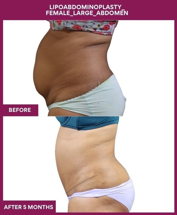3 Lipoabdominoplasty_ Female_Large_Abdomen (2)