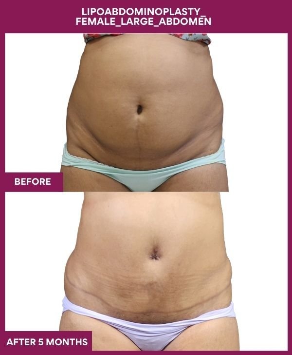 3 Lipoabdominoplasty_ Female_Large_Abdomen (4)