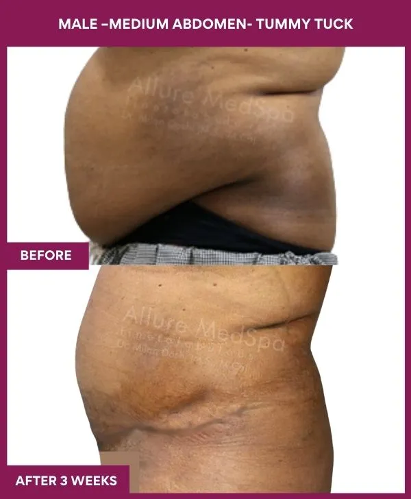 3 MALE –Medium ABDOMEN- TUMMY TUCK (2)_31