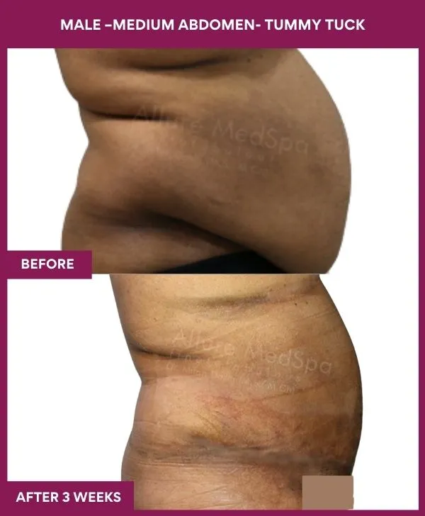 3 MALE –Medium ABDOMEN- TUMMY TUCK (3)_32