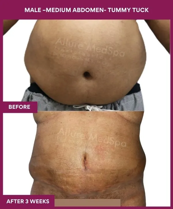 3 MALE –Medium ABDOMEN- TUMMY TUCK_33