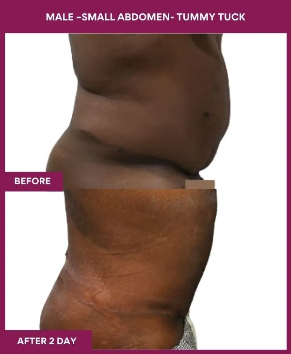 3 MALE –SMALL ABDOMEN- TUMMY TUCK (2)_34