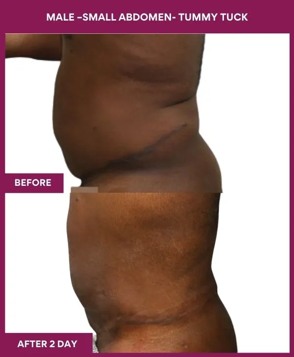 3 MALE –SMALL ABDOMEN- TUMMY TUCK (3)_35