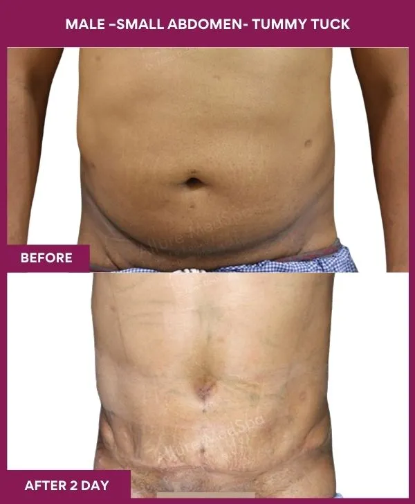 3 MALE –SMALL ABDOMEN- TUMMY TUCK_24_ (1)