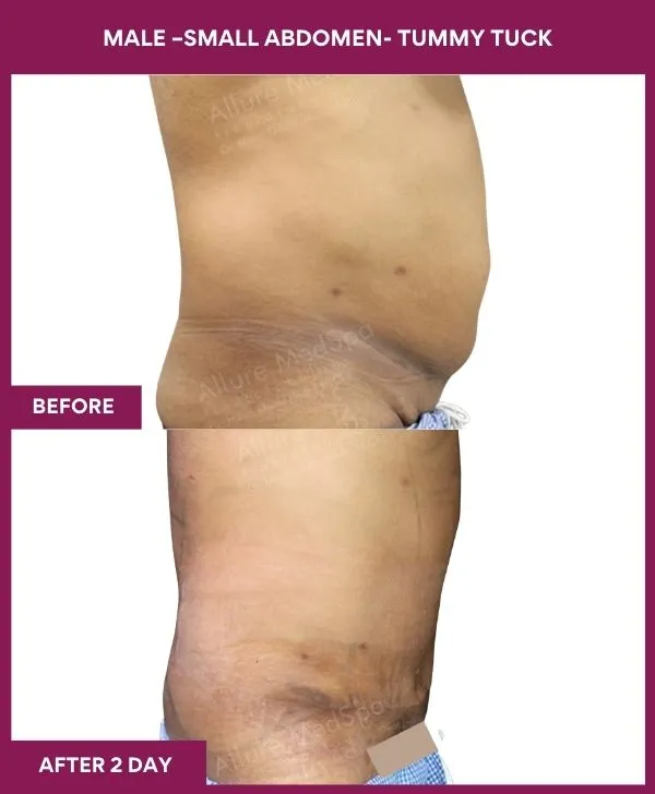 3 MALE –SMALL ABDOMEN- TUMMY TUCK_24_ (2)