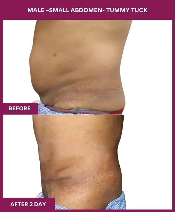 3 MALE –SMALL ABDOMEN- TUMMY TUCK_24_ (3)