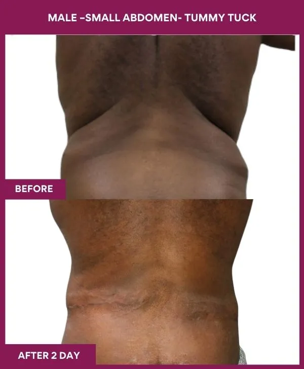 3 MALE –SMALL ABDOMEN- TUMMY TUCK_36