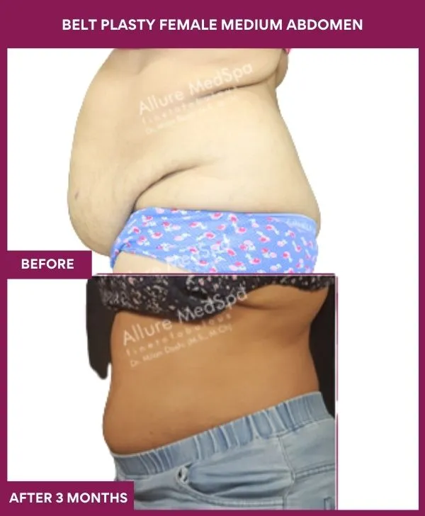 4 BELT PLASTY FEMALE MEDIUM ABDOMEn (2)_37_