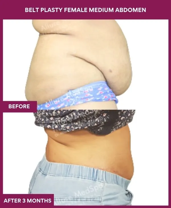 4 BELT PLASTY FEMALE MEDIUM ABDOMEn (3)_37_