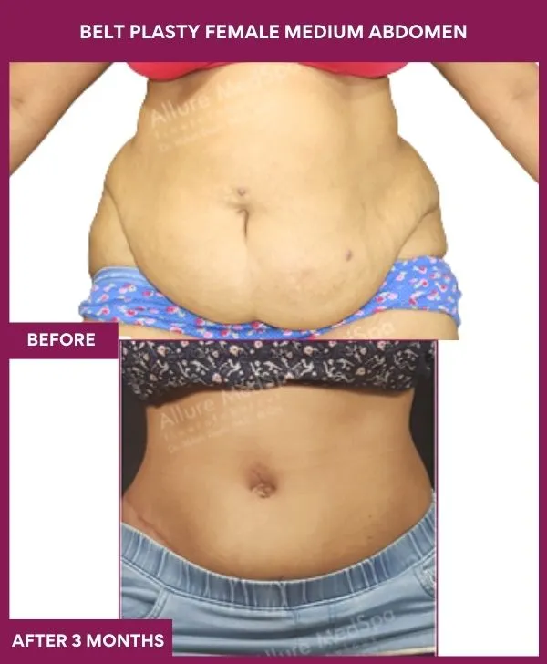 4 BELT PLASTY FEMALE MEDIUM ABDOMEn (4)_37_