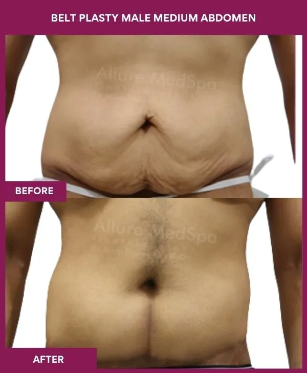 4 BELT PLASTY MALE MEDIUM ABDOMEn_42_ (1)