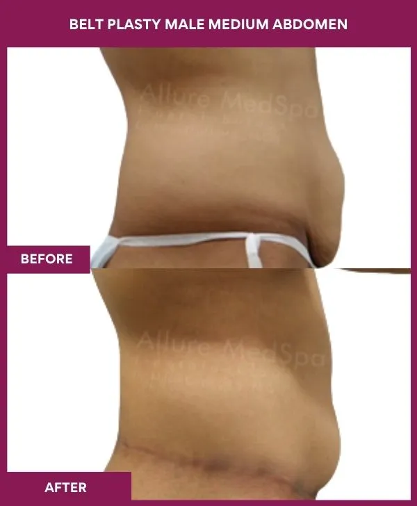 4 BELT PLASTY MALE MEDIUM ABDOMEn_42_ (2)