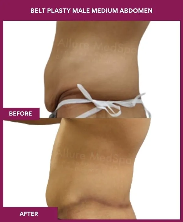 4 BELT PLASTY MALE MEDIUM ABDOMEn_42_ (3)