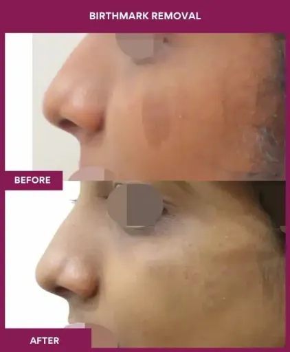 4 BIRTHMARK REMOVAL (2)