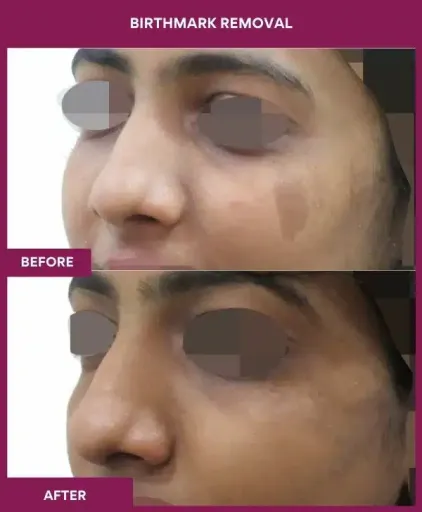 4 BIRTHMARK REMOVAL (3)