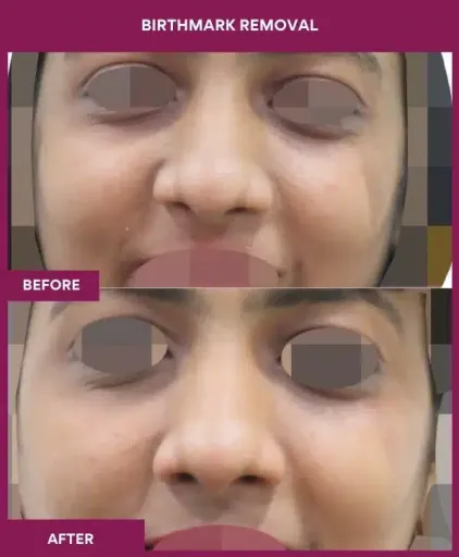 4 BIRTHMARK REMOVAL