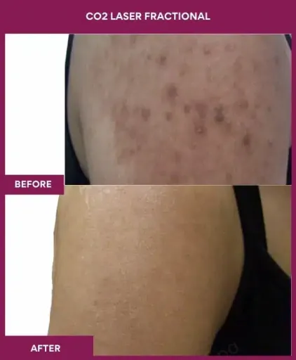 4 CO2 Laser Fractional