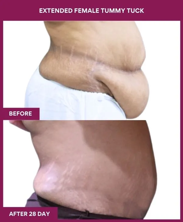 4 Extended Female Tummy Tuck (3)_53_