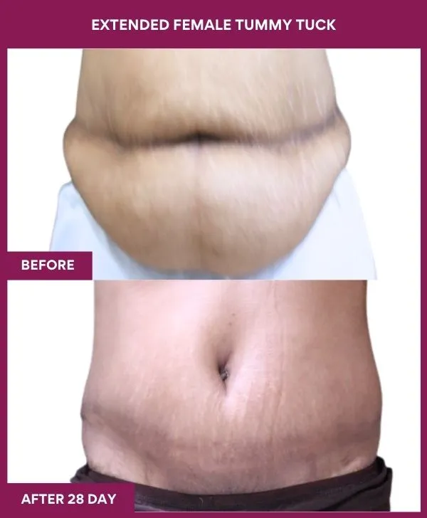 4 Extended Female Tummy Tuck (4)_53_