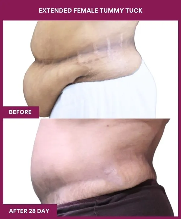 4 Extended Female Tummy Tuck (5)_53_