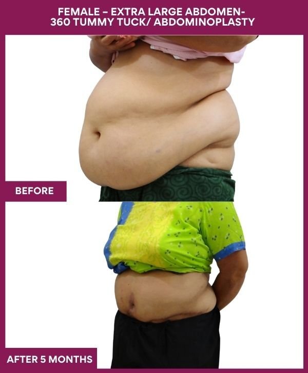 4 FEMALE – EXTRA LARGE ABDOMEN- 360 TUMMY TUCK_ ABDOMINOPLASTY (3)