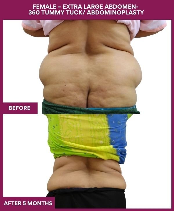 4 FEMALE – EXTRA LARGE ABDOMEN- 360 TUMMY TUCK_ ABDOMINOPLASTY (4)