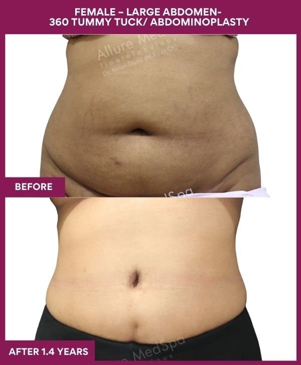 4 FEMALE – LARGE ABDOMEN- 360 TUMMY TUCK_ ABDOMINOPLASTY (1)