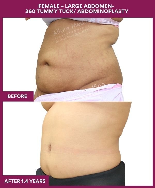 4 FEMALE – LARGE ABDOMEN- 360 TUMMY TUCK_ ABDOMINOPLASTY (3)