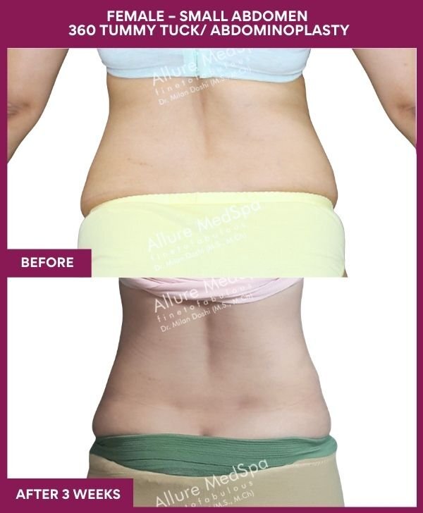 4 FEMALE – SMALL ABDOMEN 360 TUMMY TUCK_ ABDOMINOPLASTY (2)