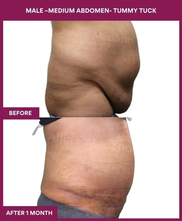 4 MALE –Medium ABDOMEN- TUMMY TUCK (2)_43