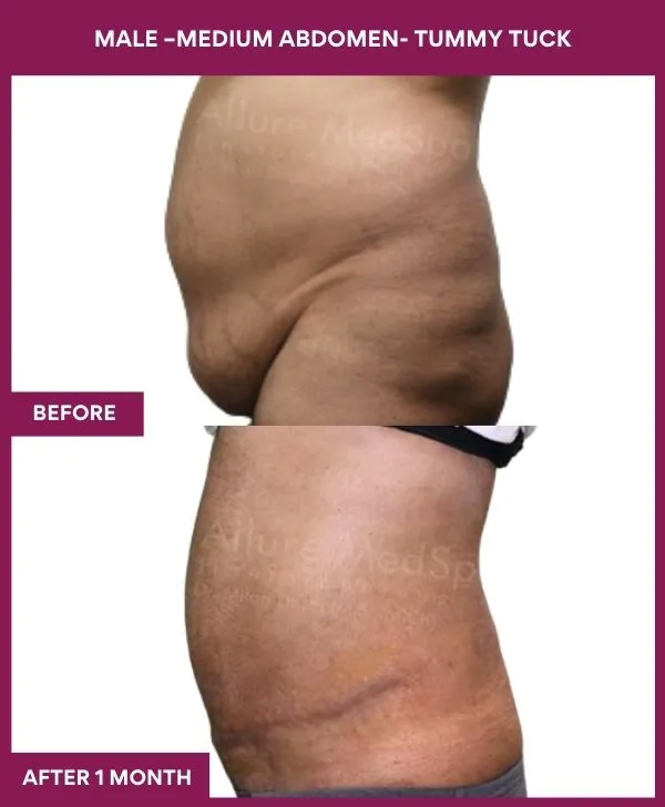 4 MALE –Medium ABDOMEN- TUMMY TUCK (3)_44