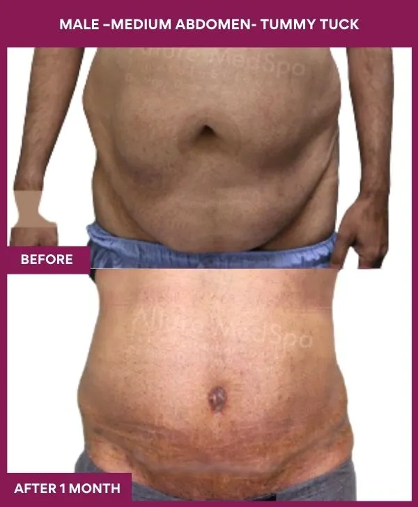 4 MALE –Medium ABDOMEN- TUMMY TUCK_45