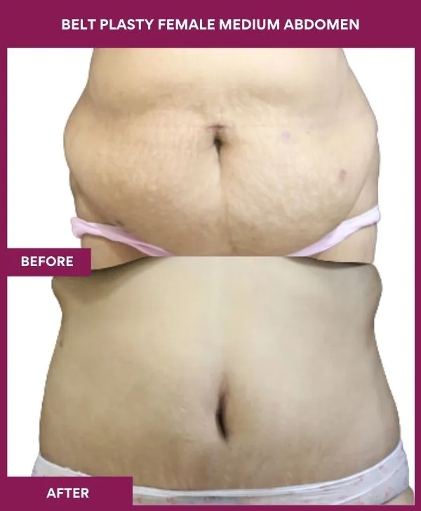 5 BELT PLASTY FEMALE MEDIUM ABDOMEn_51_ (1)