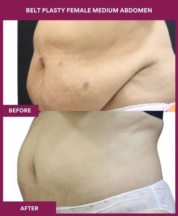 5 BELT PLASTY FEMALE MEDIUM ABDOMEn_51_ (2)