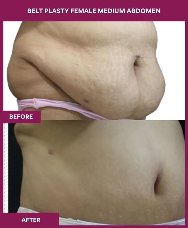 5 BELT PLASTY FEMALE MEDIUM ABDOMEn_51_ (3)