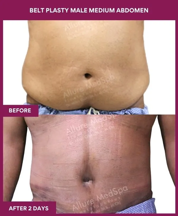 5 BELT PLASTY MALE MEDIUM ABDOMEn_54_ (1)