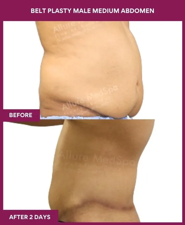 5 BELT PLASTY MALE MEDIUM ABDOMEn_54_ (2)