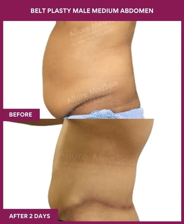 5 BELT PLASTY MALE MEDIUM ABDOMEn_54_ (3)