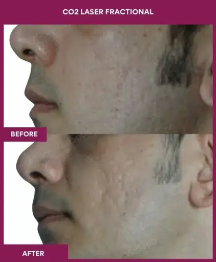 5 CO2 Laser Fractional (2)