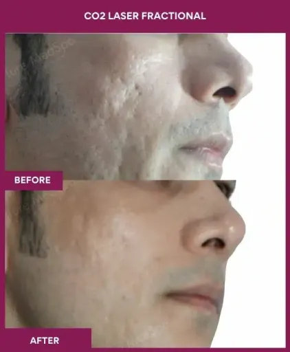 5 CO2 Laser Fractional (3)