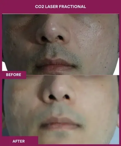 5 CO2 Laser Fractional