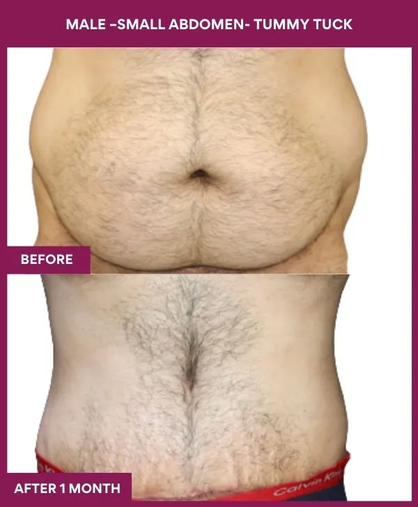 5 MALE –SMALL ABDOMEN- TUMMY TUCK_48 (1)