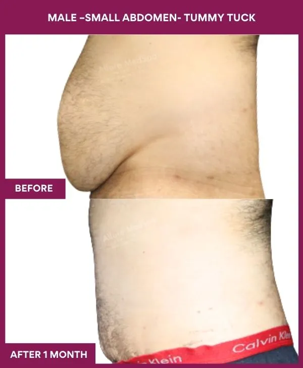 5 MALE –SMALL ABDOMEN- TUMMY TUCK_48 (2)